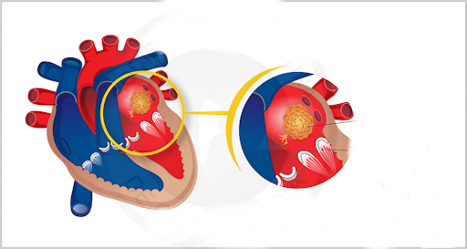 U nhầy nhĩ (Myxoma): Triệu chứng, nguyên nhân, chẩn đoán và điều trị 8 MRI tim chẩn đoán u nhầy