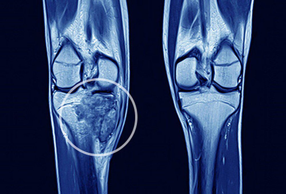 Hình ảnh sarcoma xương tổng quan