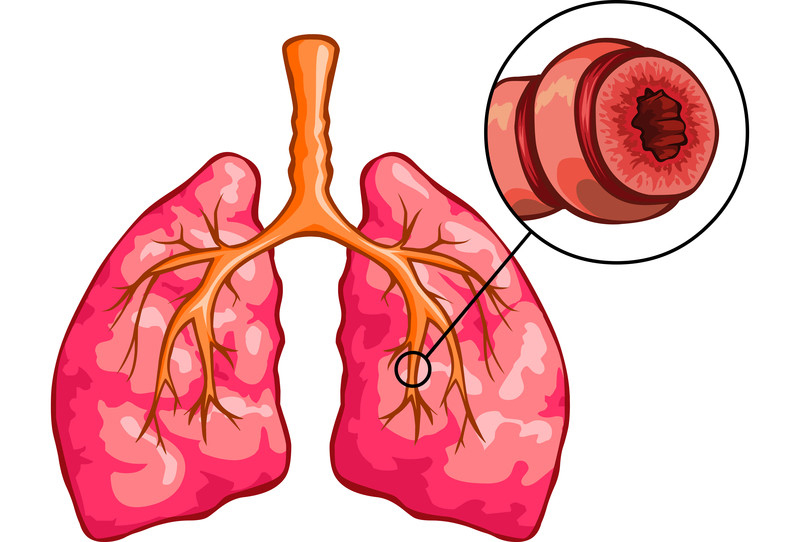 Viêm phế quản co thắt ở trẻ em