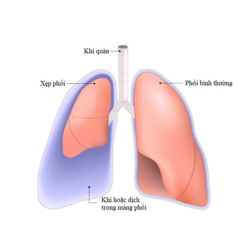 Hình ảnh X-quang tràn dịch màng phổi ác tính