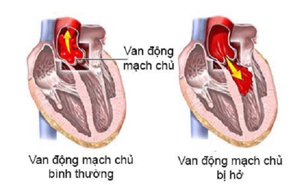 Hở Van Động Mạch Chủ Là Gì? Nguyên Nhân, Triệu Chứng Và Hướng Điều Trị 8 Phẫu thuật thay van động mạch chủ