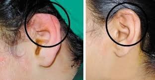 phương pháp điều trị viêm sụn tai hiệu quả