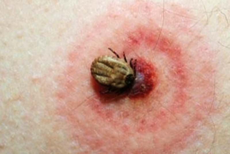 Bệnh Lyme là gì?
