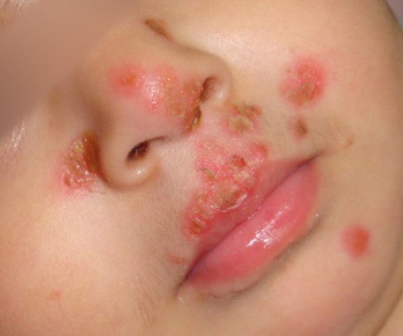 Herpes miệng ở trẻ sơ sinh
