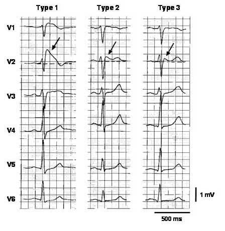 Điện tim bất thường trong hội chứng Brugada