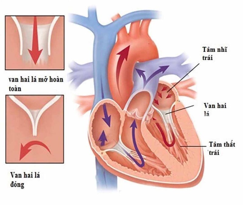 Siêu âm tim phát hiện hở van hai lá