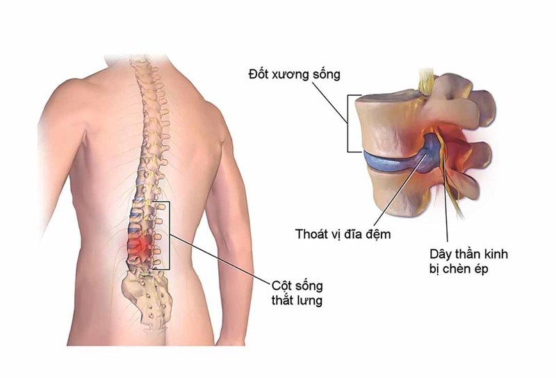 Vị trí đau vùng hông lưng