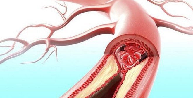 cấu trúc giải phẫu bệnh Takayasu