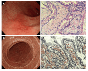 Tổn thương tim trong AL Amyloidosis
