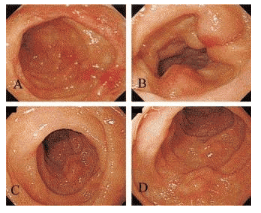 Các cơ quan bị tổn thương do AL Amyloidosis