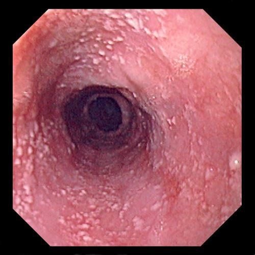 Nhiễm nấm Candida xâm lấn: Dấu hiệu, nguyên nhân và cách điều trị hiệu quả 8 Triệu chứng nhiễm Candida xâm lấn