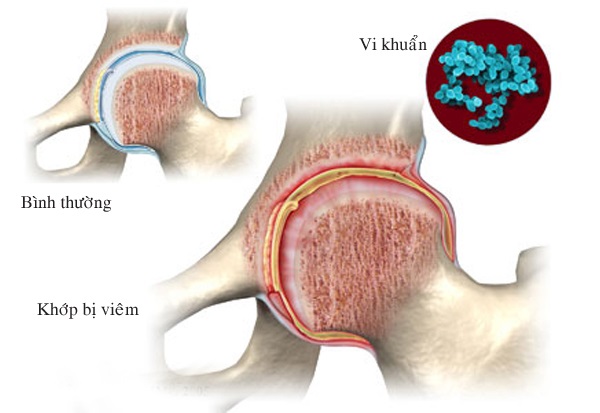 Viêm khớp nhiễm khuẩn khớp gối