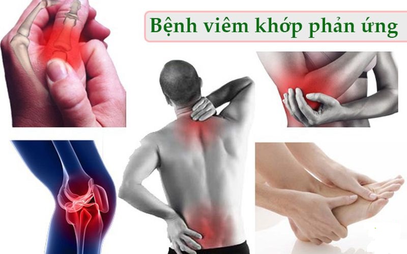 Viêm khớp phản ứng là gì