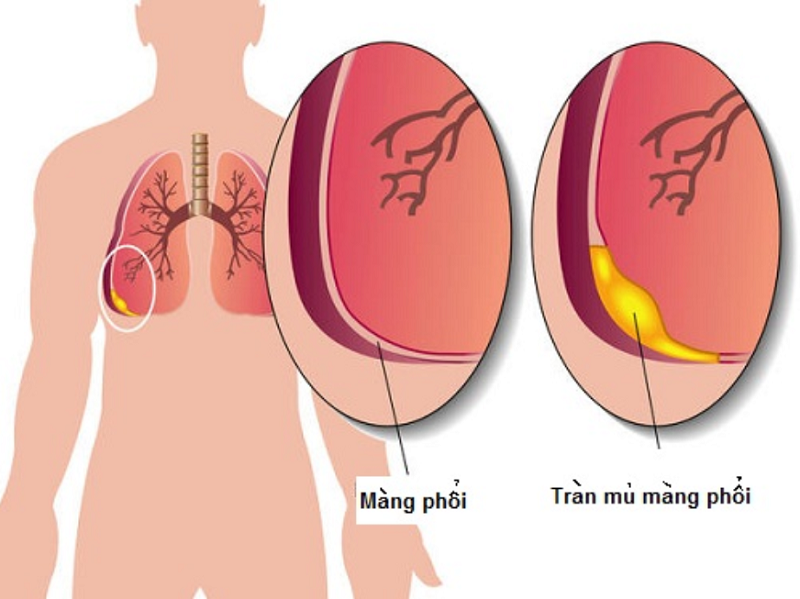 Viêm màng phổi do lao: Triệu chứng, nguyên nhân và hướng điều trị hiệu quả 8 Mủ màng phổi do lao