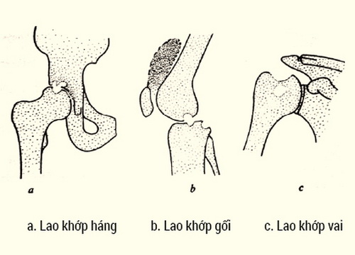 Hình ảnh lao khớp