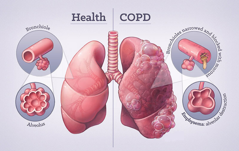 Người mắc COPD thường bị hụt hơi
