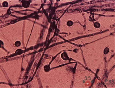 Biểu hiện ngoài da Blastomycosis