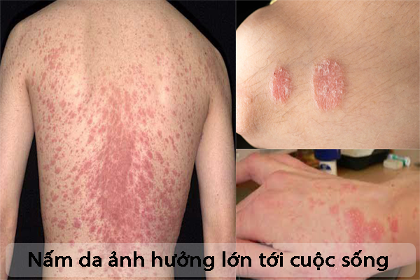 Nấm da vùng chân