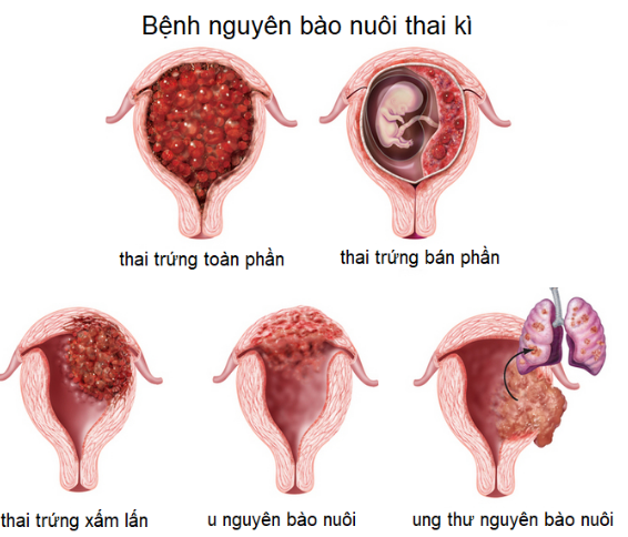 Mô phỏng u nguyên bào nuôi xâm lấn