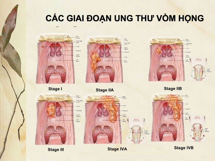 Chẩn đoán ung thư mũi bằng hình ảnh học
