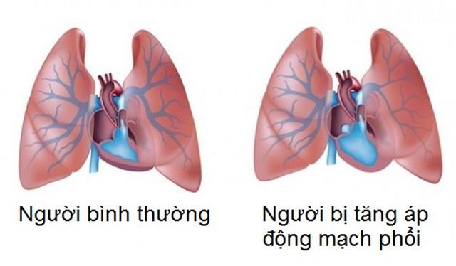 Siêu âm tim phát hiện tăng áp phổi