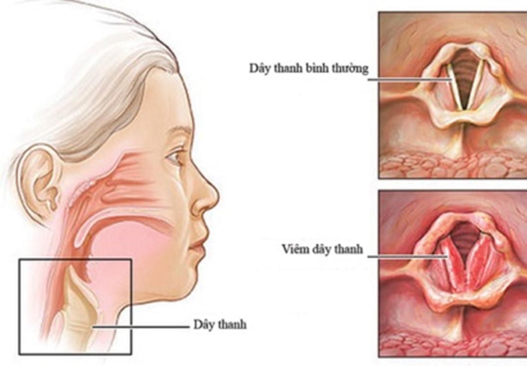 Viêm Thanh Quản Cấp Tính Là Gì? 7 Triệu chứng viêm thanh quản cấp tính
