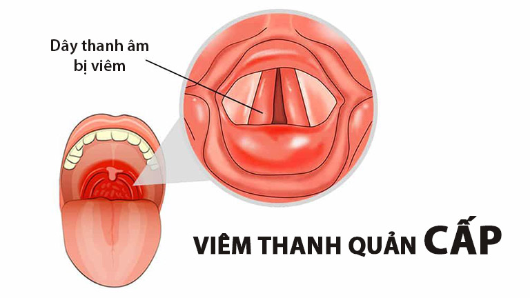 Viêm Thanh Quản Cấp Tính Là Gì? 8 Hình ảnh nội soi viêm thanh quản cấp