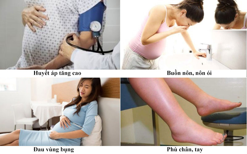 Sản giật: Biến chứng nguy hiểm đe dọa tính mạng thai phụ 7 co giật khi mang thai