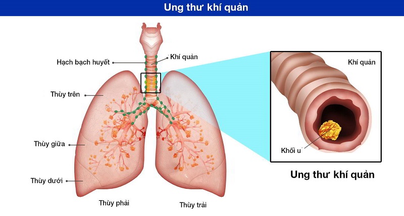 Hình ảnh nội soi u tế bào hạt ở khí quản
