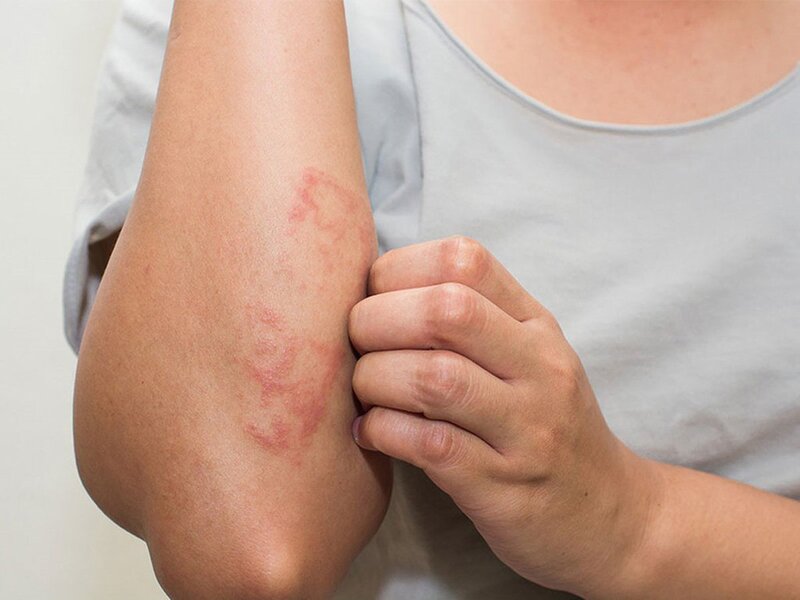 Vi khuẩn Nocardia gây bệnh Nocardiosis