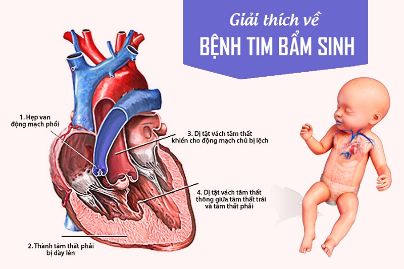 Biểu hiện bệnh tim bẩm sinh ở trẻ
