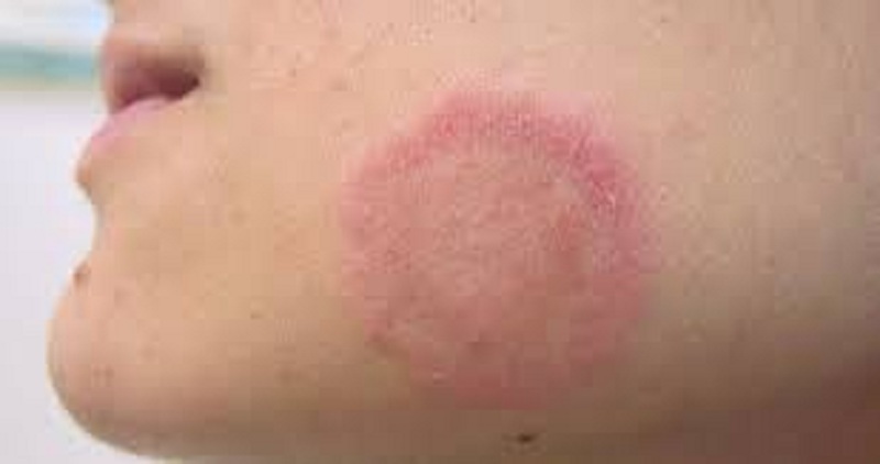 Nguyên nhân gây nhiễm nấm máu