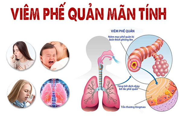 Đường thở bị hẹp lại do viêm mạn tính