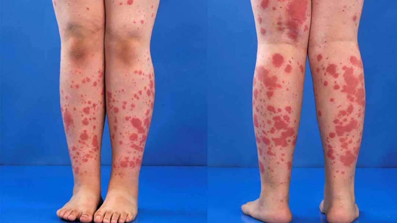hình ảnh tổn thương mạch máu