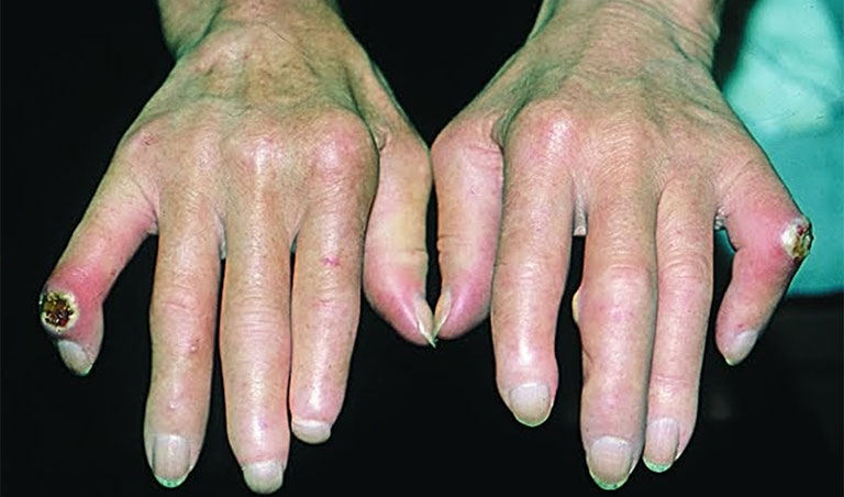 tăng áp động mạch phổi trong xơ cứng bì