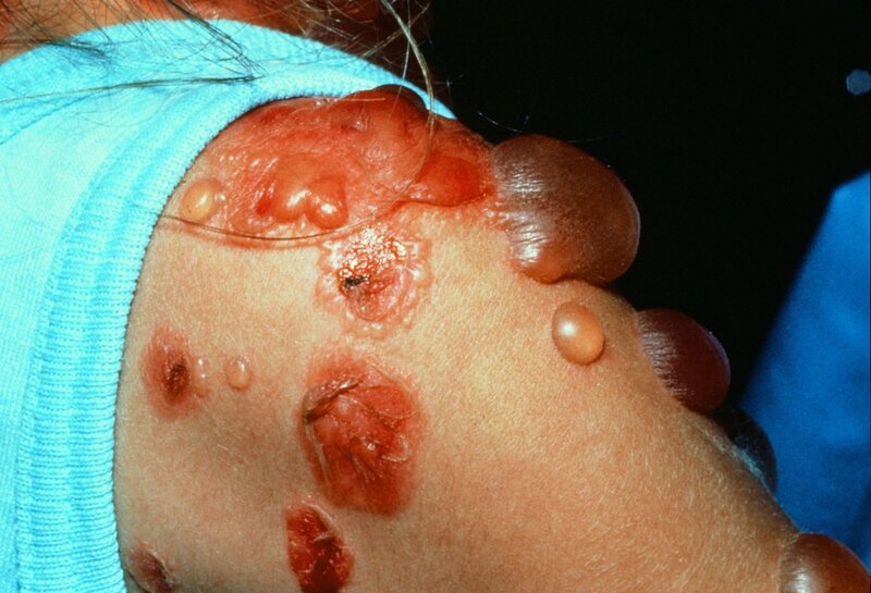 Tổn thương da do Pemphigus