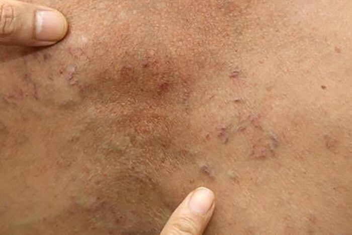 Nhiễm Sán Dây (Taeniasis): Bệnh Nguy Hiểm Thường Gặp Ở Người 8 Hình ảnh sán dây trong ruột người