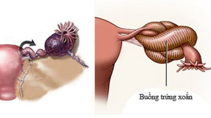Xoắn buồng trứng là gì