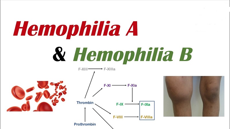 Hemophilia B là gì