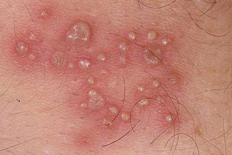 Giai đoạn phát triển của mụn rộp