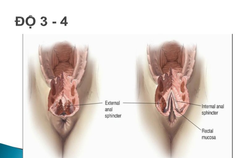 Hình ảnh mô phỏng rách sinh dục độ 3