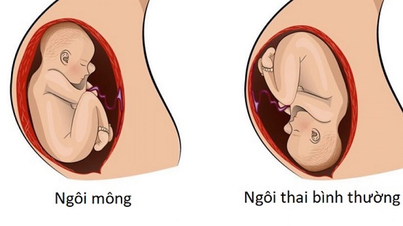 Hình ảnh minh họa ngôi thai bất thường