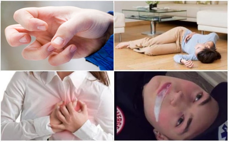 Triệu chứng động kinh cục bộ