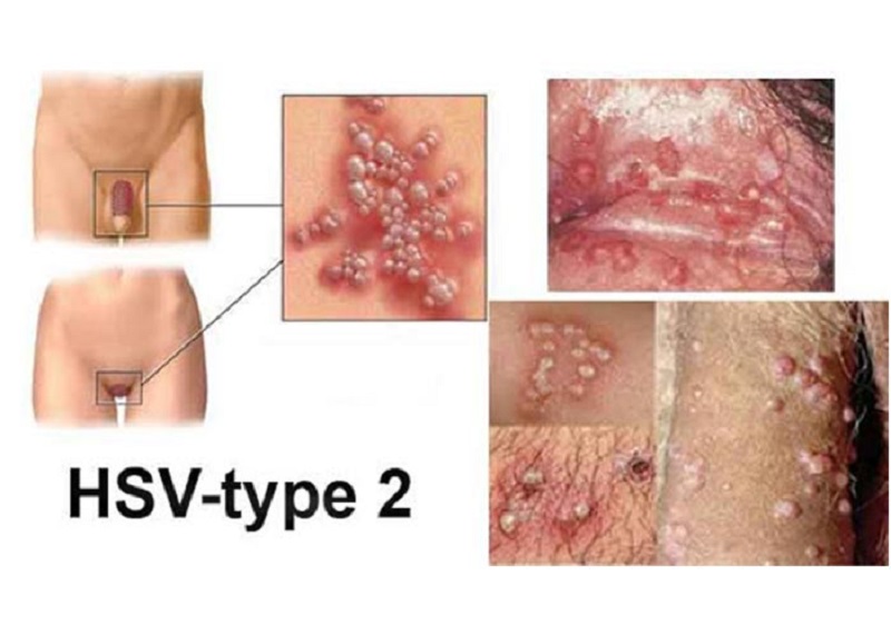Herpes sinh dục là gì? Tổng quan về bệnh mụn rộp sinh dục 8 Hình ảnh điều trị herpes sinh dục