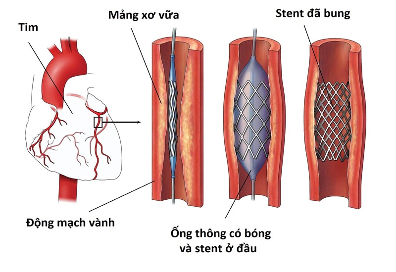 Triệu chứng tái hẹp trong stent