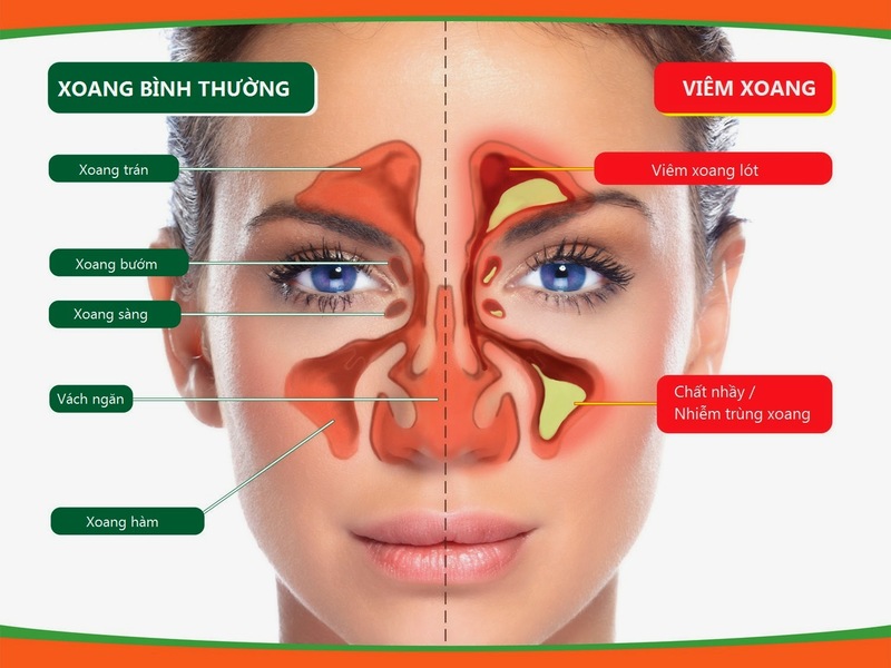 Cấu trúc giải phẫu xoang bướm