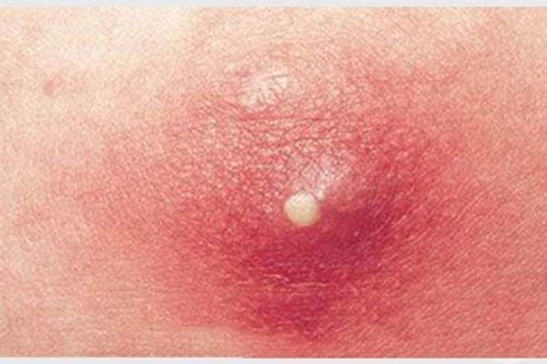 Dấu hiệu mụn nhọt có mủ