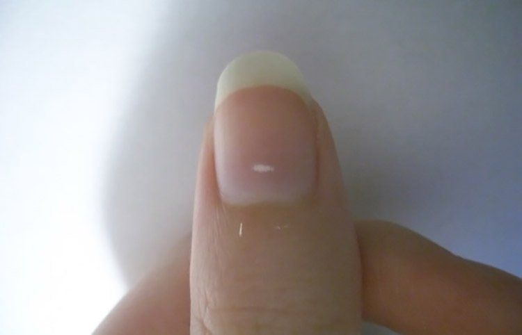 Móng tay có đốm trắng