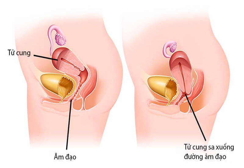 Hình ảnh minh họa sa tử cung