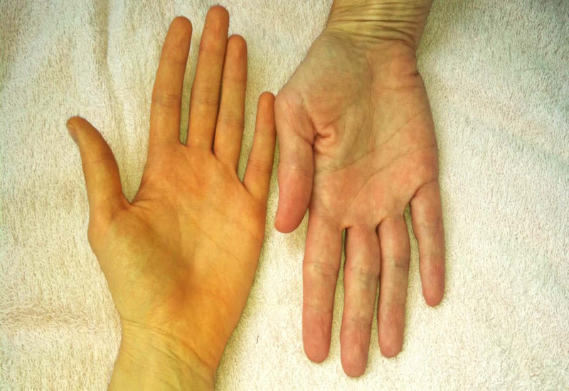 Gan bị tổn thương gây vàng da
